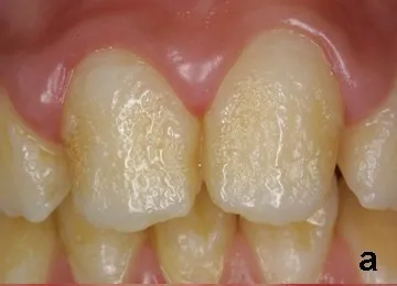 Teeth with pitted, ridged enamel from hypoplastic amelogenesis imperfecta