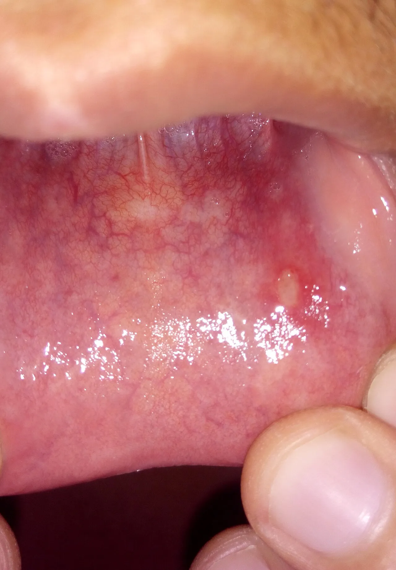 A round ulcer with a yellow center and red border on the inner lip