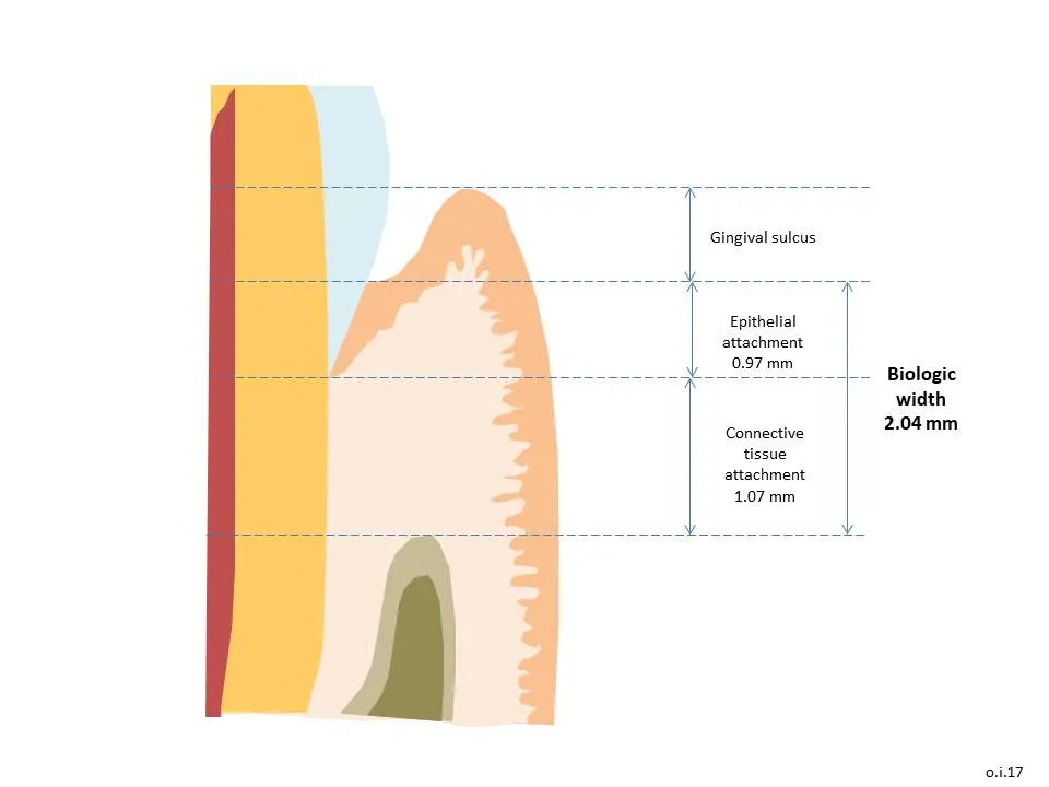Diagram of the tissues above the bone crest: the gingival sulcus, the epithelial attachment and the connective tissue attachment, with their average heights