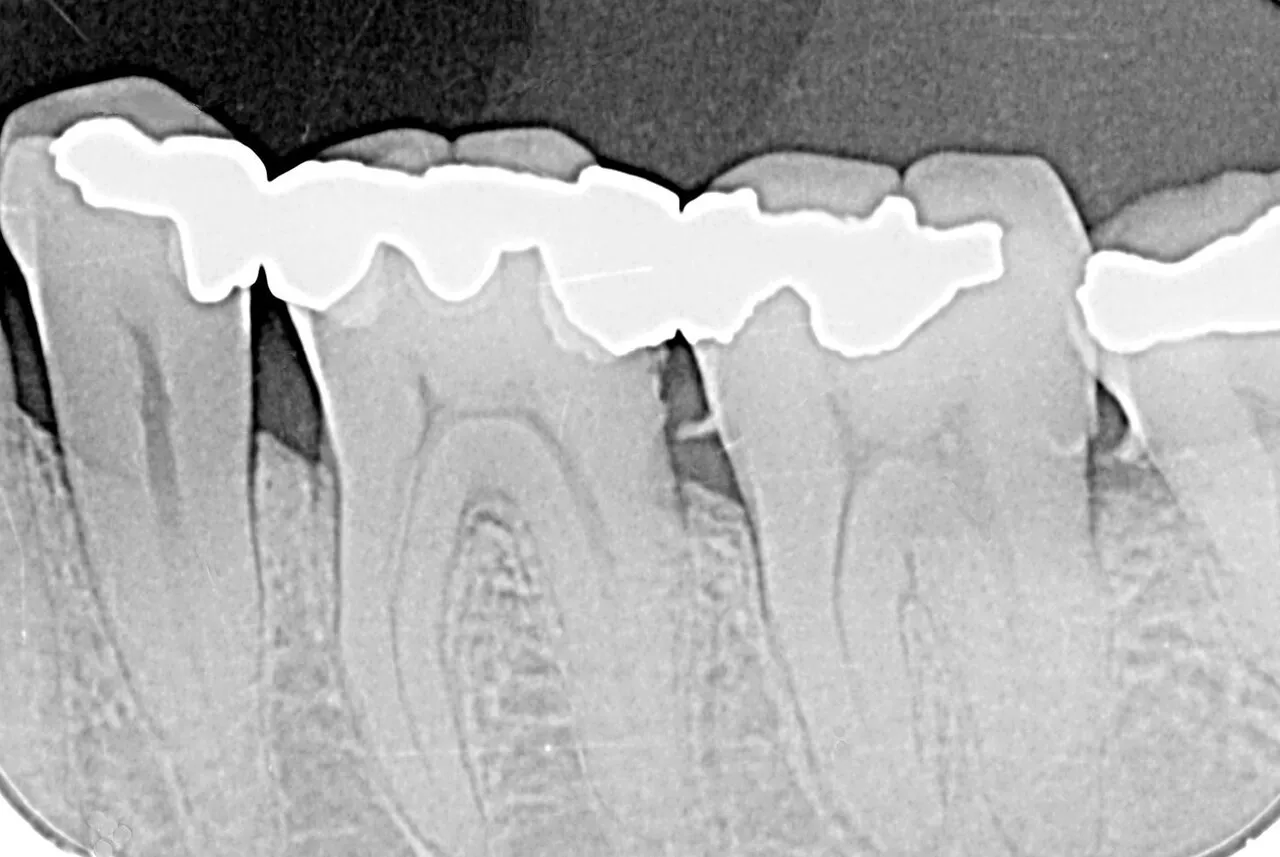 Radiograph of mandibular posterior teeth under a metal bridge, with small radiopaque calculus spurs on the proximal root surfaces and reduced crestal bone