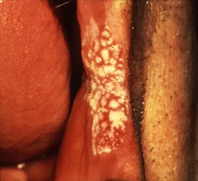 A speckled patch of white flecks on a red base on the buccal mucosa near the corner of the mouth