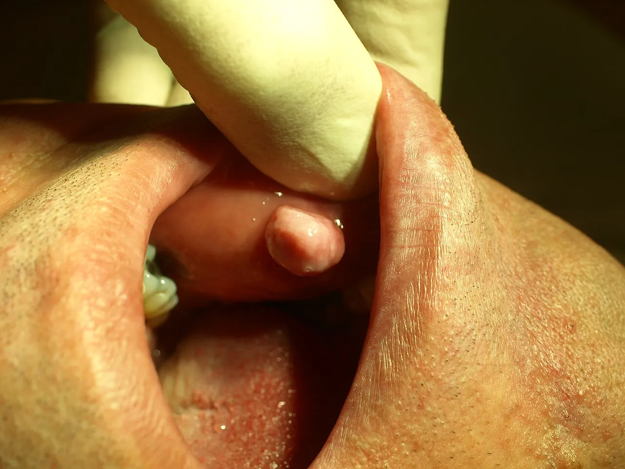 A firm, smooth, pink nodule on the buccal mucosa