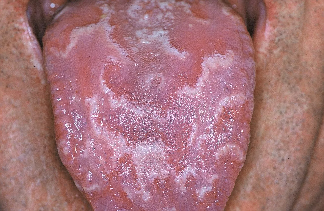 Smooth red patches outlined by raised white borders across the top of the tongue