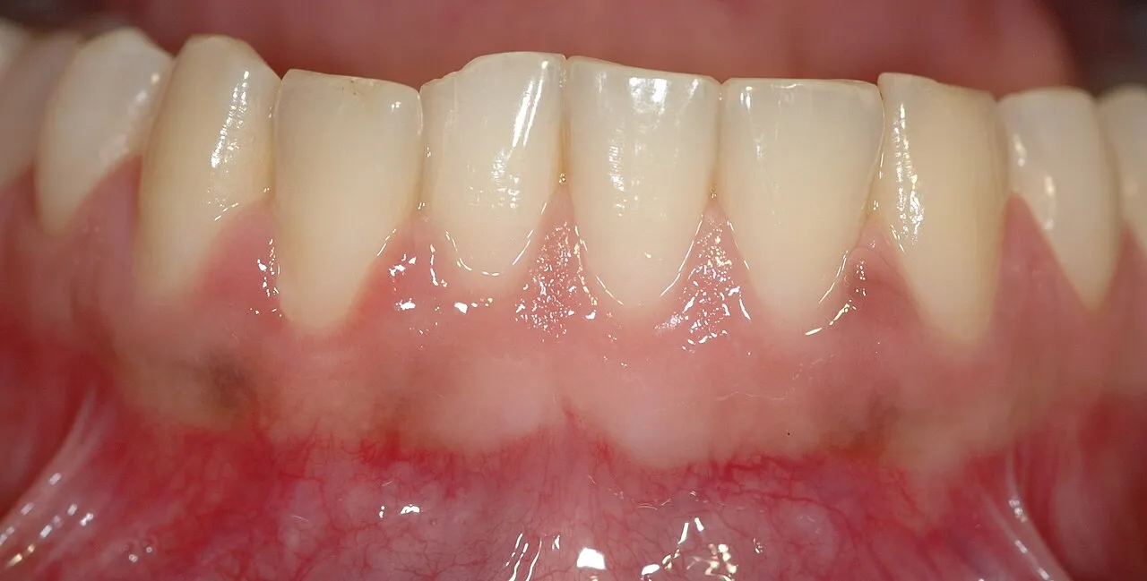 Mandibular anterior gingiva that is pink and firm, with knife-edge margins and papillae filling the spaces between the teeth