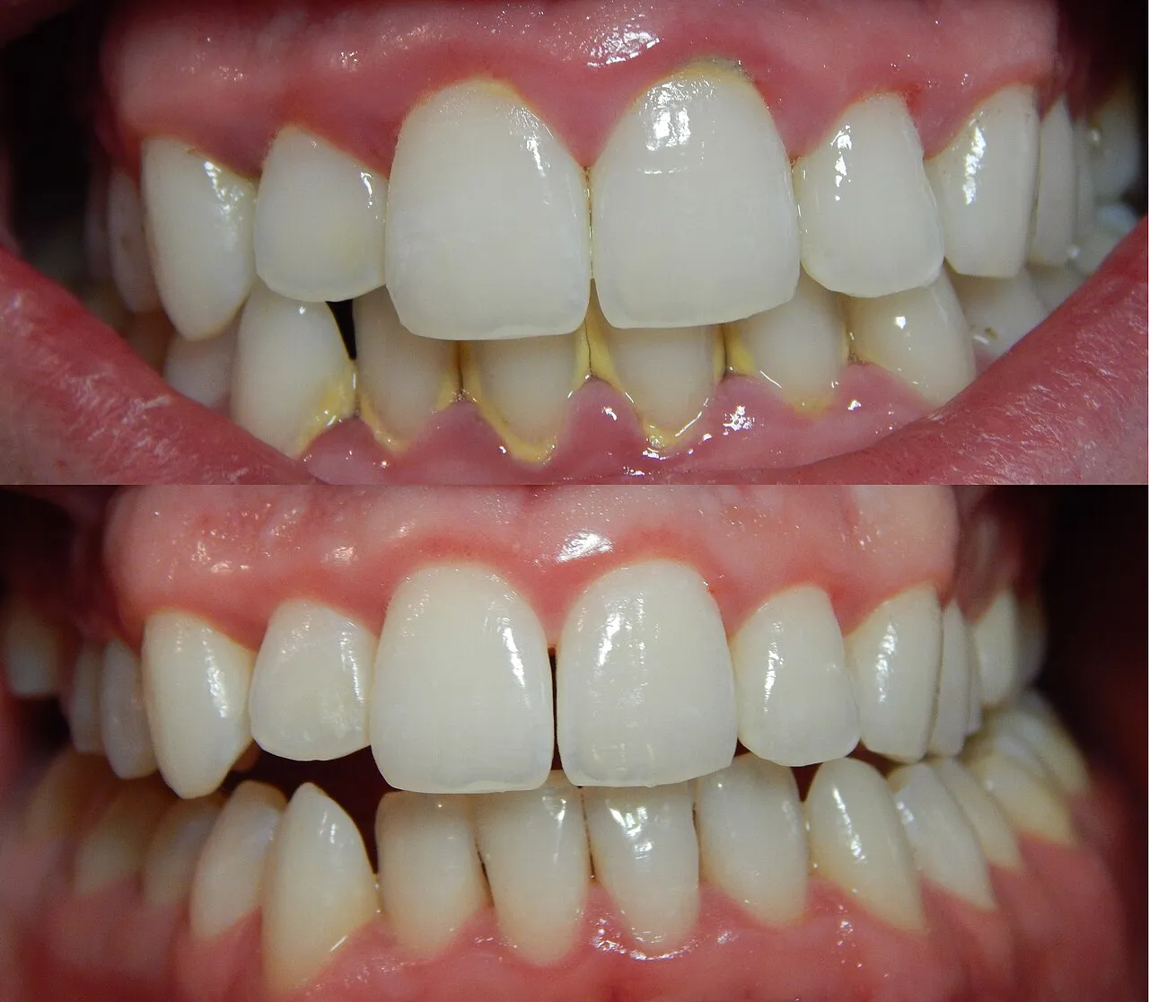Two photos of the same mouth: red, swollen gingiva with deposits before scaling, and firmer, paler gingiva nine days after scaling