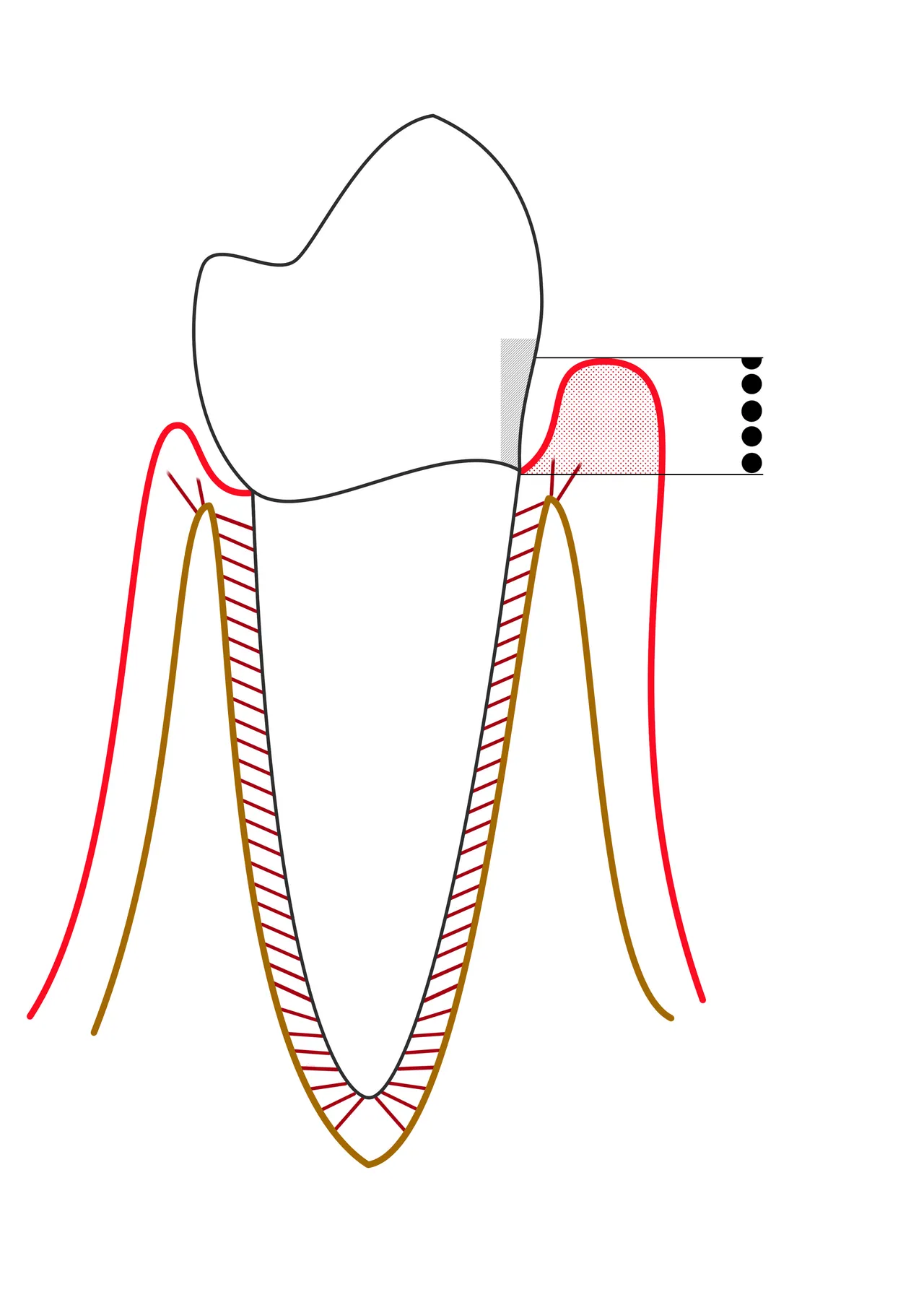 Line diagram of a tooth in which swollen gingiva deepens the probing depth while the attachment and bone stay at their normal level