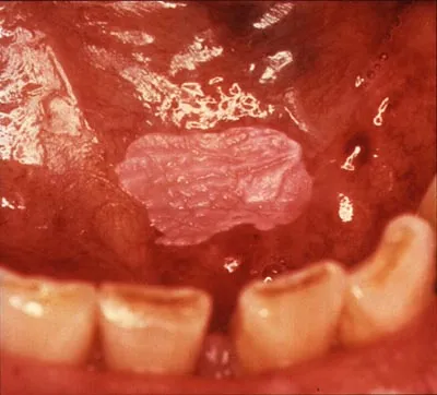 A flat, even white patch on the floor of the mouth