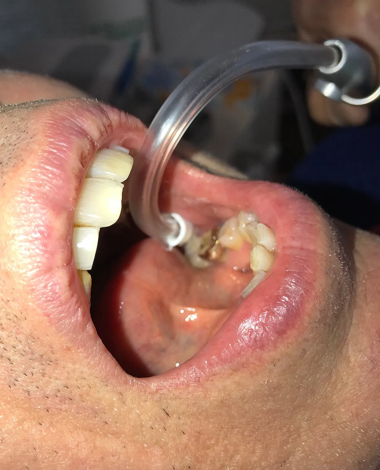 A saliva ejector placed in a patient's mouth