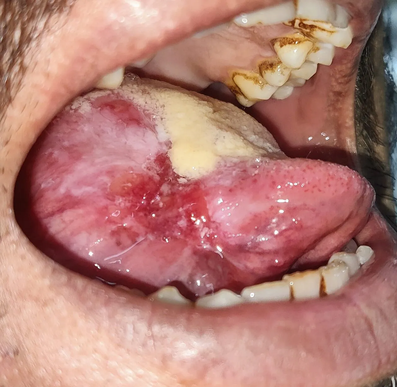 The tongue extended to one side, showing a red and white ulcerated lesion with a yellow surface on its lateral border