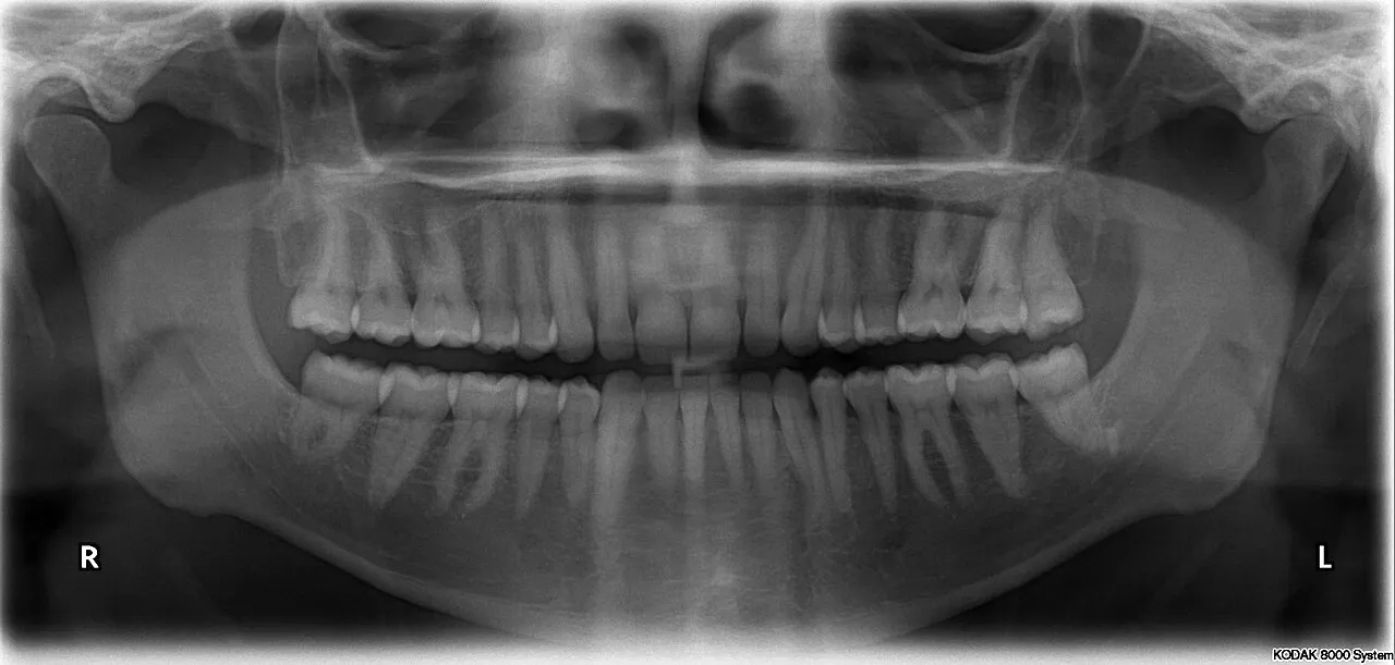 Panoramic radiograph of a full set of 32 permanent teeth with no restorations, useful for tracing normal landmarks such as the maxillary sinus, nasal fossa and mandibular canal
