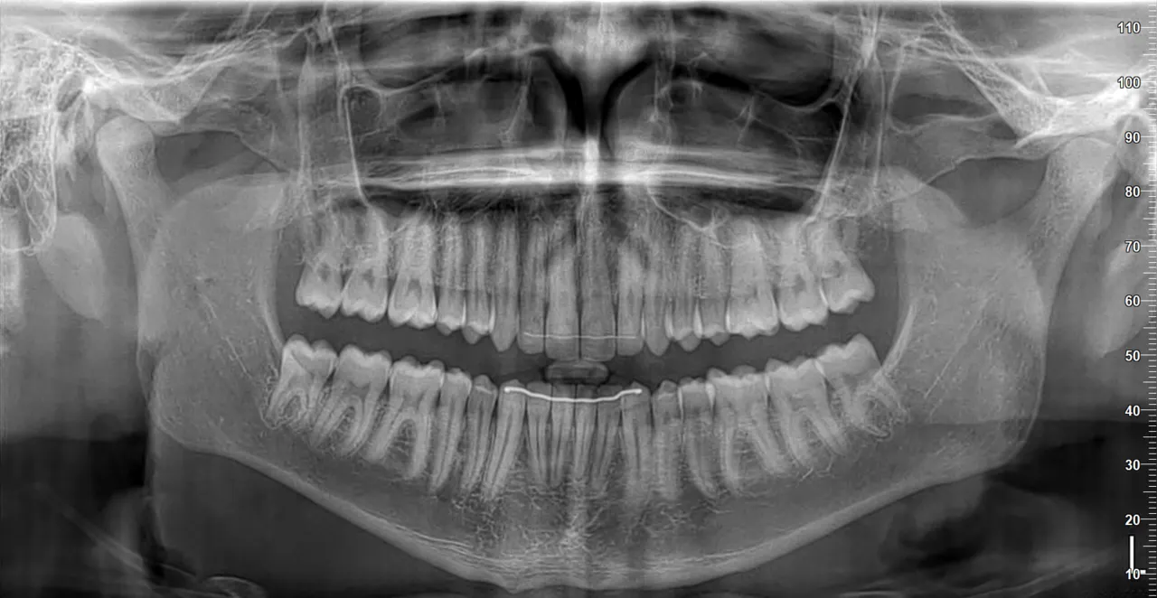 Panoramic radiograph of an adult with a full permanent dentition, a flat to gently curved occlusal plane and a measuring scale at the right edge
