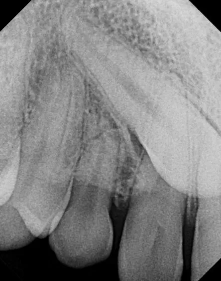 Periapical radiograph of the maxillary anterior region with a canine lying at a slant above the roots of the neighboring teeth; a second image with a shifted horizontal angle and the SLOB rule would show whether it sits buccal or palatal