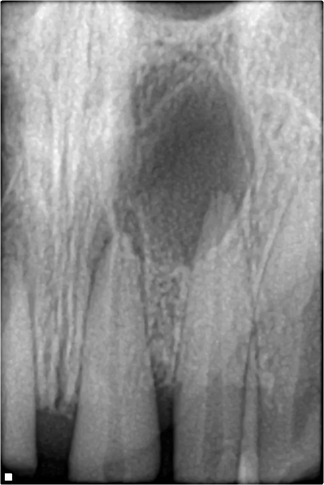Periapical radiograph of maxillary anterior teeth with a large, well-defined dark area at the root tip