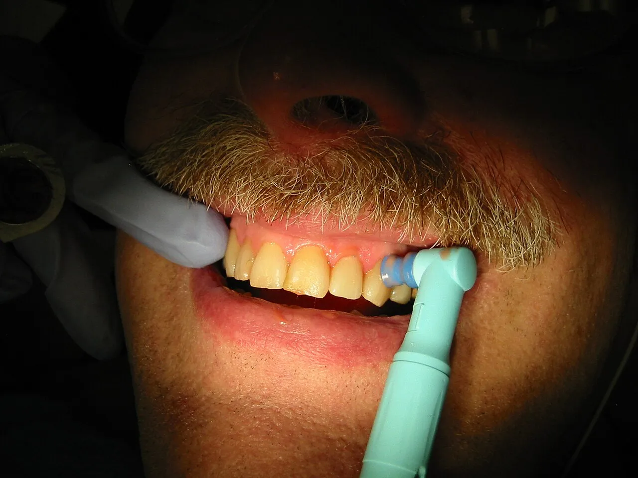 A prophy angle with a rubber cup polishing the facial surfaces of a patient's maxillary teeth