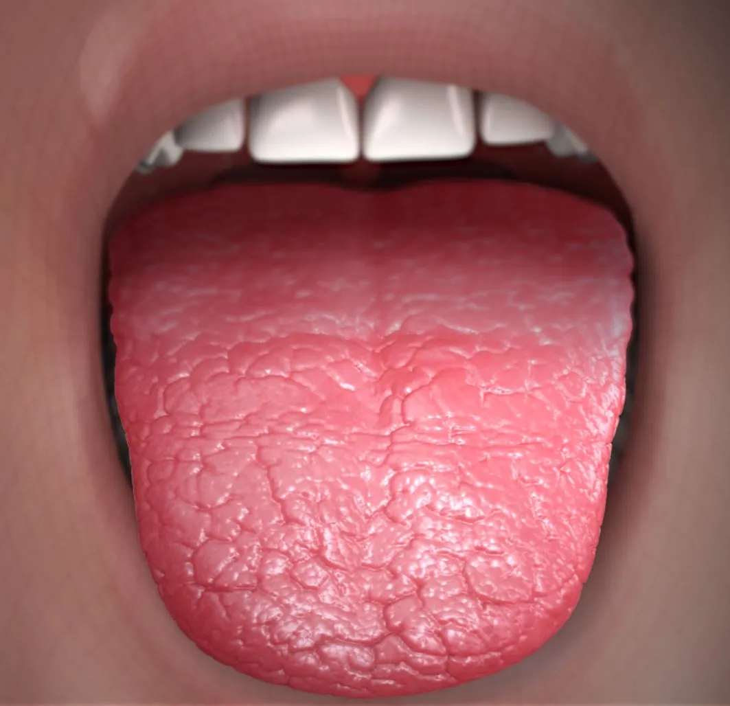 3D illustration of a dry, rough, fissured tongue in a patient with reduced saliva